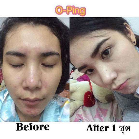 O-ping Whitenning Cream (โอปิ๊ง ไวท์เทนนิ่ง ครีม) หน้าใสไร้สิว