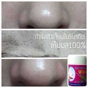 ครีมลอกสิวเสี้ยน เวียดนาม สูตรสิวกระเจิง ราคา 50 บาท 10 ชิ้น 40 บาท