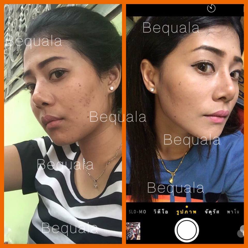 ครีมบีควอล่า(bequala) ชุดทดลอง เปลี่ยนหน้าสิวให้เป็นหน้าใสเห็นความเปลี่ยนแปลงภายใน 7 วัน !! ราคา 300 บาท