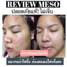 MESO BLINK SET LERICH เมโส สะกิดหน้าใส แก้ทุกปัญหา
