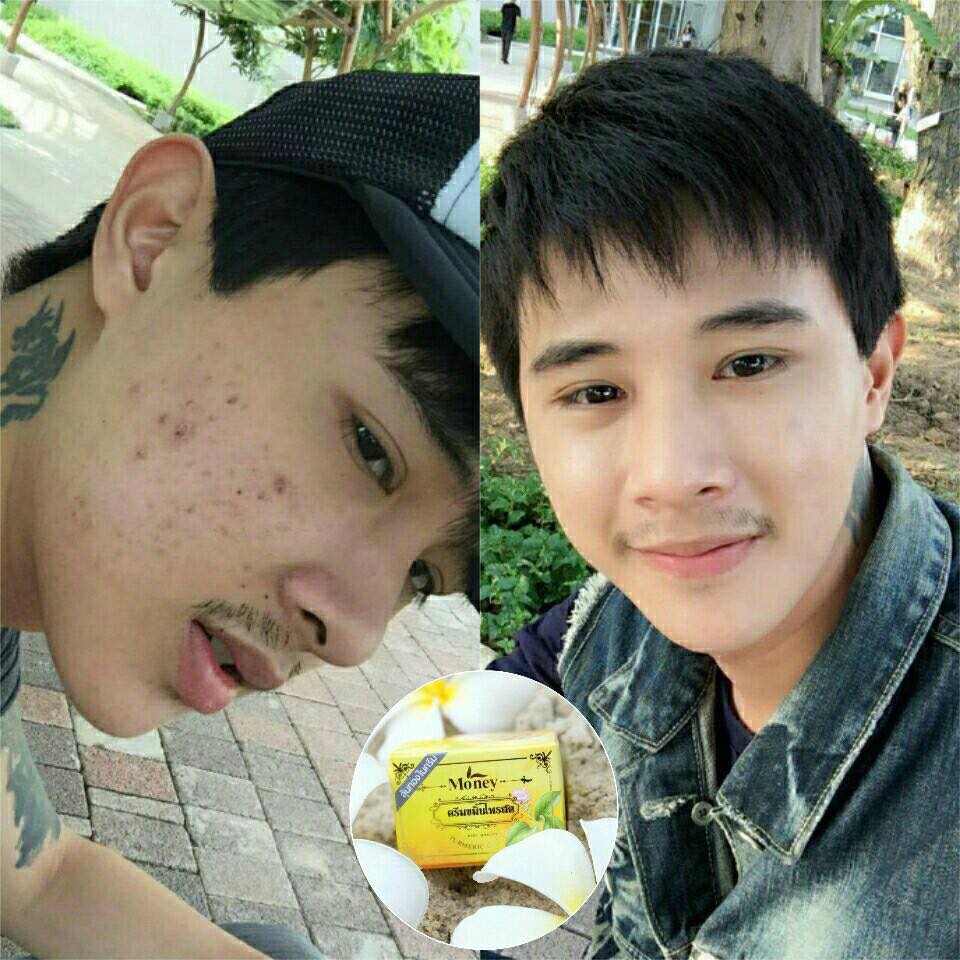 ครีมขมิ้นไพรสด มันนี่ Turmeric Cream by Money 5 g. รักษารอยสิว ฝ้า กระ จุดด่างดำ