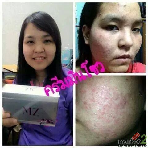Minzol Cream ครีมมินโซว ราคา 450 บาท Line : fujimate