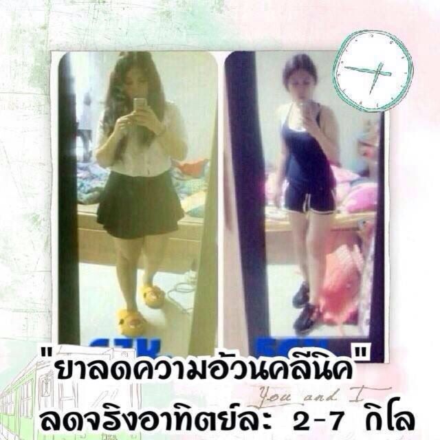 ยาลดน้ำหนักคลีนิคชุดลดน้ำหนักดื้อยา ระดับ 3 ได้ผลดี เผาผลาญดีเยี่ยม คลินิค รพ.ชั้นนำนิยมใช้เคสพิเศษ... ราคาชุดละ 350 บาท