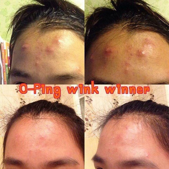 O-ping Whitenning Cream (โอปิ๊ง ไวท์เทนนิ่ง ครีม) หน้าใสไร้สิว