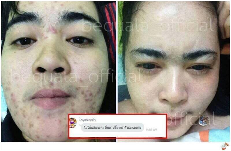 ครีมบีควอล่า(bequala) ชุดทดลอง เปลี่ยนหน้าสิวให้เป็นหน้าใสเห็นความเปลี่ยนแปลงภายใน 7 วัน !! ราคา 300 บาท