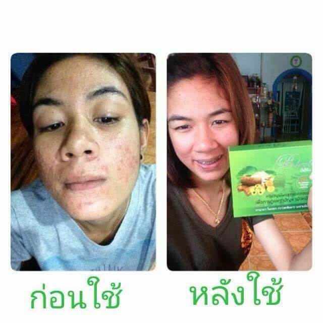 B Herb บีเฮิร์บ ครีมสมุนไพรสูตรมหัศจรรย์ รักษาสิว ฝ้า กระ จุดด่างดำ